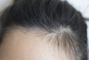 頭皮のカサカサ・かゆみの対処法！乾燥を防ぐ6つの方法
